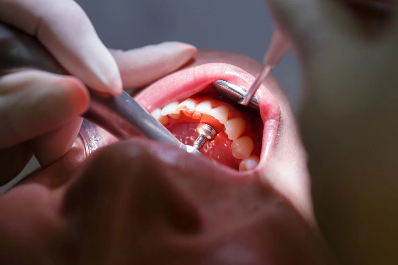 Choroby przyzębia – jak je rozpoznać i kiedy reagować?